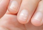 Tırnaklardaki Beyaz Lekeler