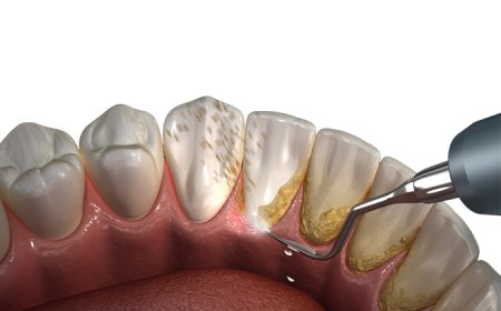 Diş Temizleme Seanslarını Ne Sıklıkta Yaptırmalısınız?